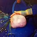 Large ovarian cyst