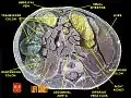 Cross-section through a cadaveric specimen showing the position of the kidneys.