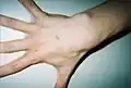 Hand of 37-year-old patient showing interdigital webbing