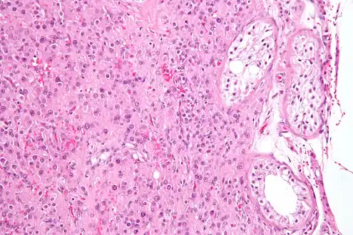 Intermediate magnification micrograph of a Leydig cell tumour, H&E stain