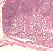 Micrograph of metastatic papillary thyroid carcinoma to a lymph node. H&E stain.