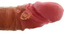 LGV ulcer on a penis