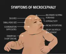 symptoms of microcephaly