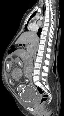 Median plane CT scan of a pregnant woman. The fetus (exposed in the coronal plane) is 37 weeks of gestational age.