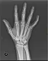 X-ray image of right hand with thumb on left.