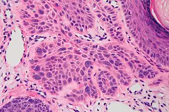 High magnification demonstrates the pleomorphism of the invading keratinocytes