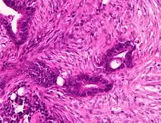 Moderately-to-poorly differentiated colorectal carcinoma