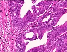 Moderately differentiated colorectal carcinoma