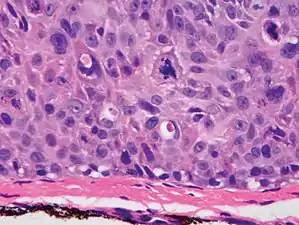 cSCC in situ, high magnification, demonstrating an intact basement membrane.