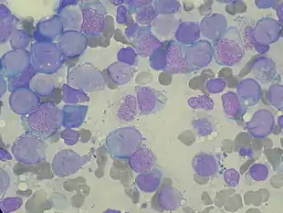 Bone marrow aspirate showing acute myeloid leukemia with Auer rods in several blasts