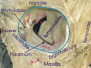 1 Anterior ethmoidal foramen, 2 Optic foramen, 3 Superior orbital fissure, 4 Lacrimal sac, 5 Infraorbital groove, 6 Inferior orbital fissure, 7 Infraorbital foramen