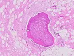 Bone formation may be seen in both lipomas and liposarcomas (a well-differentiated one pictured).