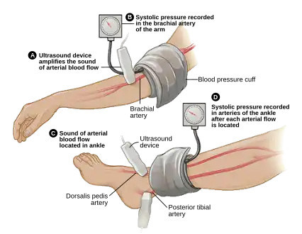 ABI testing is used by vascular surgeons in the diagnosis of PAD. The blood pressure in the arm and leg are compared as a ratio.