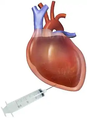 Pericardiocentesis: fluid aspiration of hemorrhagic effusion