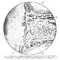 Calcified cartilage, hemorrhage in fibrous marrow, and abnormally thin bone cortex due to scurvy