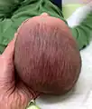 Left posterior plagiocephaly (positional case)