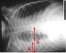 An X-ray showing a chest lying horizontally. The lower black area, which is the right lung, is smaller with a whiter area below it of a pulmonary effusion. Red arrows indicate size.