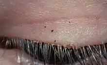 Pubic lice on the eyelashes