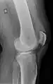 Quadriceps tendon rupture in plain X-ray: Incomplete rupture with haematoma in tendon.