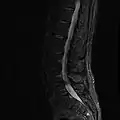 MRI lumbar spine with degeneration (sagittal FAST STIR)