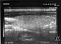 Fig. 2Ultrasonic: Cross section of the right lobe