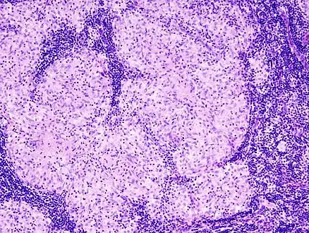 Sarcoidosis in a lymph node