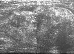 Fig. 5 Ultrasonography of a liposarcoma with high-echo areas reflected from its lipomatous matrix and low-echo areas reflected from its non-lipomatous areas.