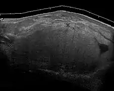 Fig. 6 Ultrasonography of a liposarcoma mimicking a lipoma. This homogeneous high-echoic mass has the same appearance as a lipoma.