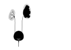 Pelvi-ureteric junction obstruction - easily mistaken for cystic renal disease on early scans