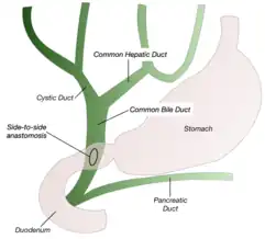 Side-to-Side Anastomosis