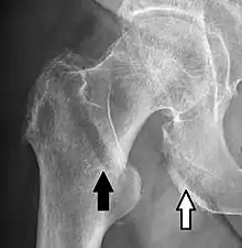 A hip fracture (black arrow) next to a skin fold (white arrow).