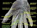 Common palmar digital branches of median nerve