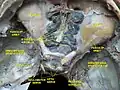 Ethmoid sinus. Ethmoidal air cells.Deep dissection. Superior view.