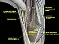 Anterior interosseous nerve.Deep dissection.Anterior.