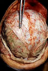 Autopsy. Dura mater is retracted by the forceps.