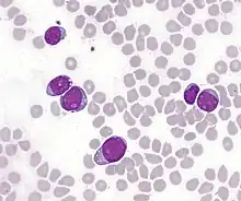 T-lymphoblastic cells of acute leukemia in the bone marrow