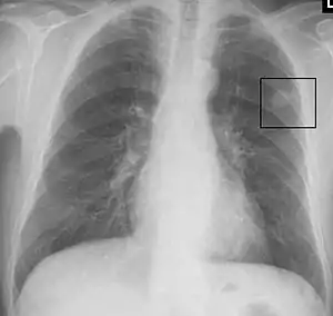 lung nodule