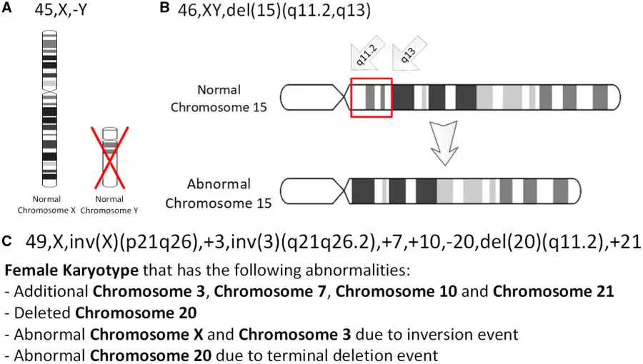 Three chromosomal abnormalities with ISCN nomenclature, with increasing complexity: (A) A tumour karyotype in a male with loss of the Y chromosome, (B) Prader–Willi Syndrome i.e. deletion in the 15q11-q12 region and (C) an arbitrary karyotype that involves a variety of autosomal and allosomal abnormalities.