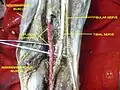 Common fibular (peroneal) nerve