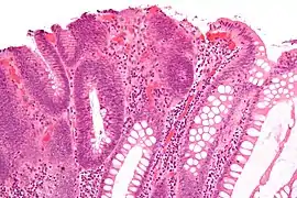 Micrograph of a tubular adenoma, the most common type of dysplastic polyp in the colon