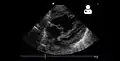 4-month-old with pulmonary hypertension as seen on ultrasound