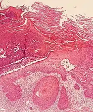 Invasive nests with characteristic large celled centers. Ulceration (at left) is common in invasive cSCC.