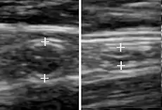 A normal appendix without and with compression. Absence of compressibility indicates appendicitis.