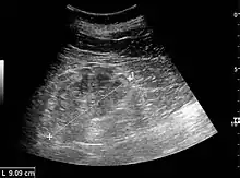 Chronic renal disease caused by glomerulonephritis with increased echogenicity and reduced cortical thickness. Measurement of kidney length on the US image is illustrated by '+' and a dashed line.