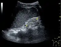 Figure 25. End-stage chronic kidney disease with increased echogenicity, homogenous architecture without visible differentiation between parenchyma and renal sinus and reduced kidney size. Measurement of kidney length on the US image is illustrated by ‘+’ and a dashed line.