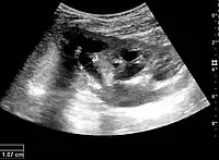 Figure 16. Hydronephrosis with dilated anechoic pelvis and calyces, along with cortical atrophy. The width of a calyx is measured on the US image in the longitudinal scan plane, and illustrated by ‘+’ and a dashed line.