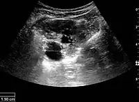 Figure 17. Same patient as in Figure 16 with measurement of the pelvis dilation in the transverse scan plane illustrated on the US image with ‘+’ and a dashed line.