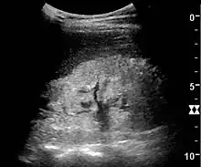 Figure 23. Nephrotic syndrome. Hyperechoic kidney without demarcation of cortex and medulla.