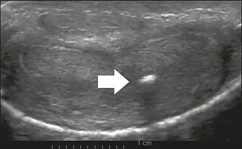 Transverse ultrasound of the penis, in a ventral view, in the middle portion of the penis. Note the echoic image with posterior acoustic shadowing, corresponding to calcification (arrow), in the left corpus cavernosum.