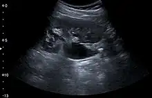 Renal ultrasonograph of a stone located at the pyeloureteric junction with accompanying hydronephrosis.